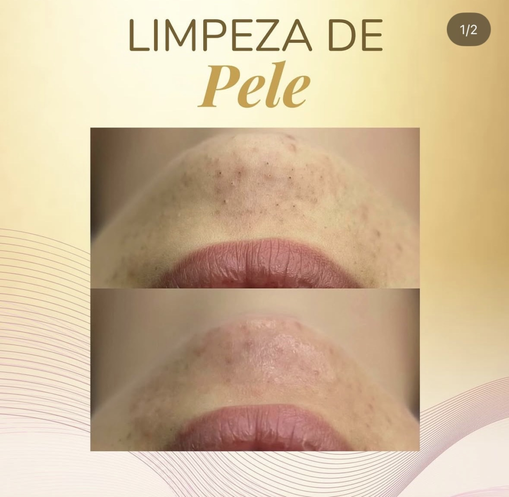 Limpeza de Pele