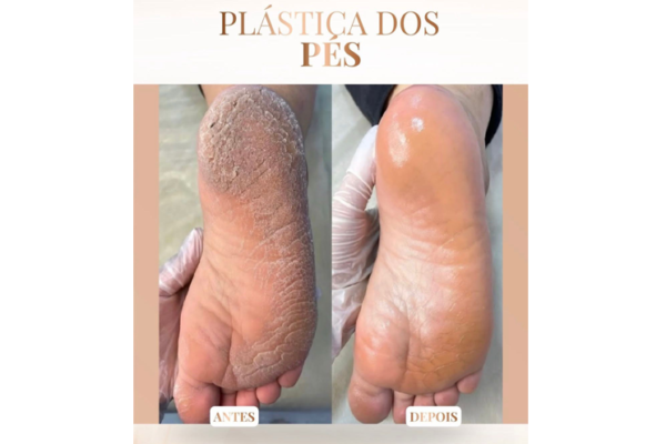 Clínica Joanna Mattos – Plástica dos Pés